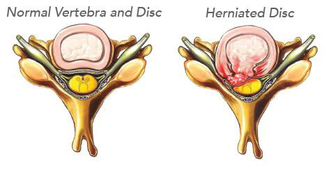 herniated-disc