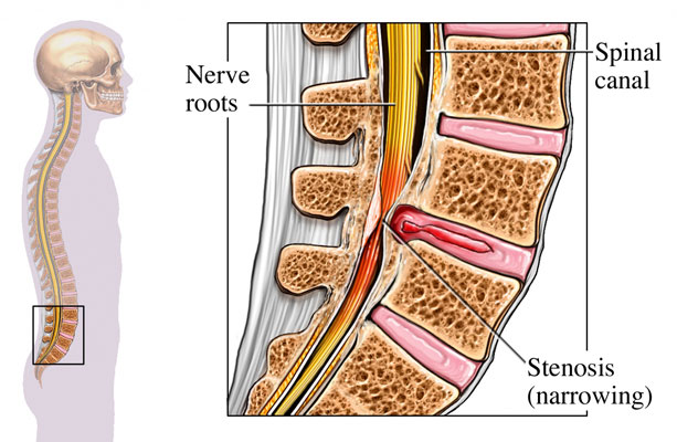 Spinal-Stenosis